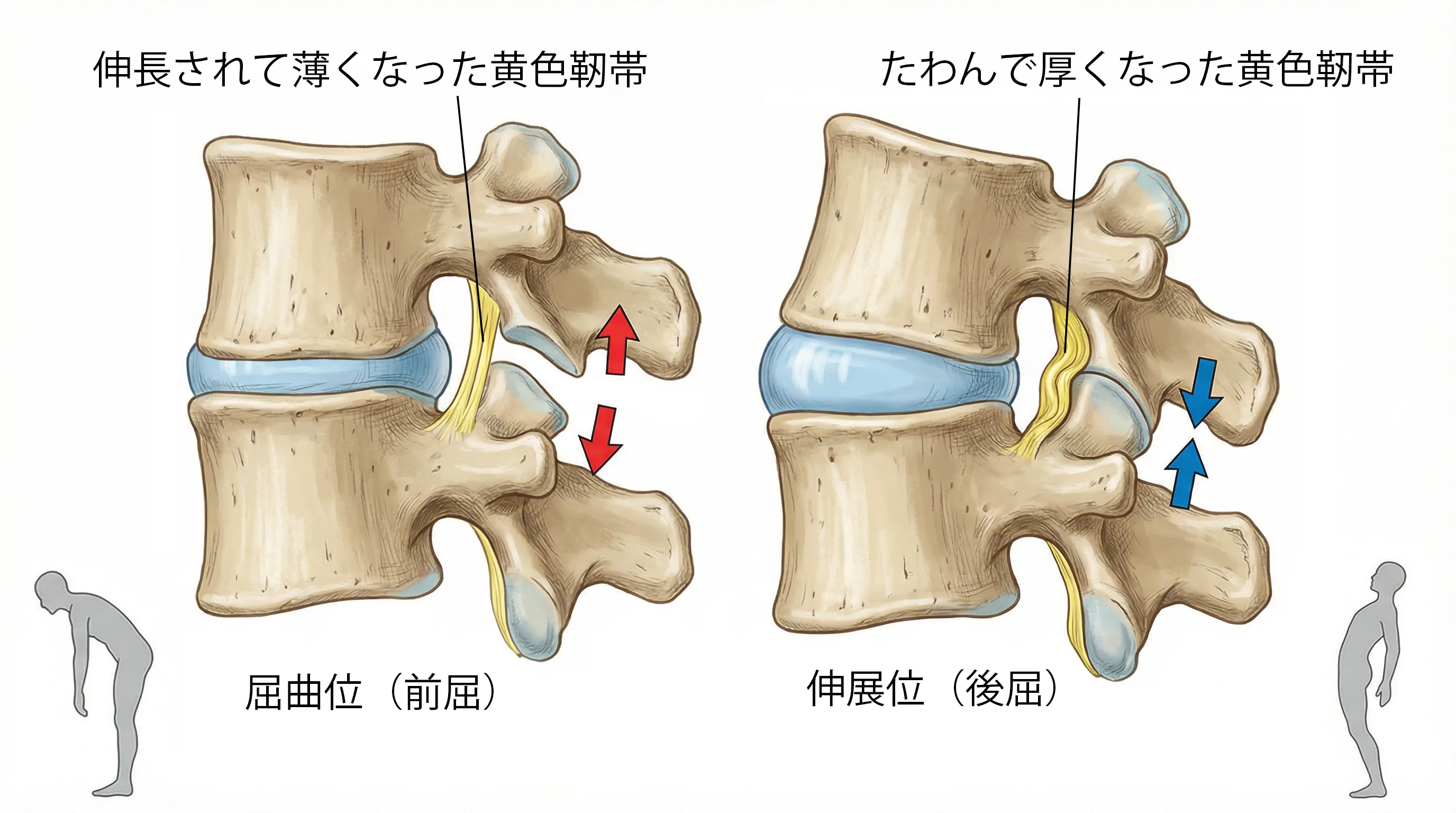 前屈と後屈時の脊柱管の変化：前屈では黄色靭帯がのびて薄くなり、後屈ではたわんで厚くなる