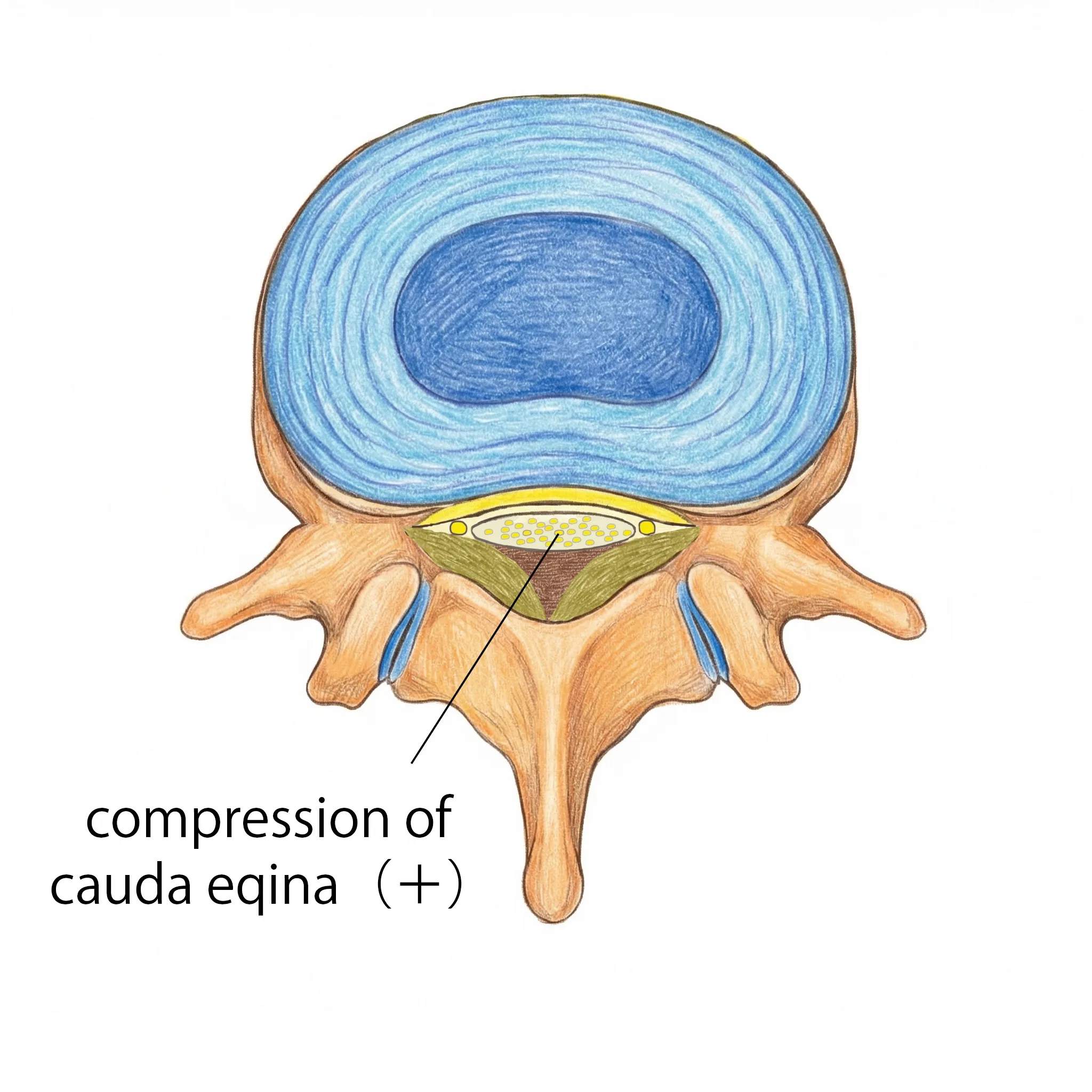 Central stenosis: the center of the spinal canal is narrowed, compressing the nerves