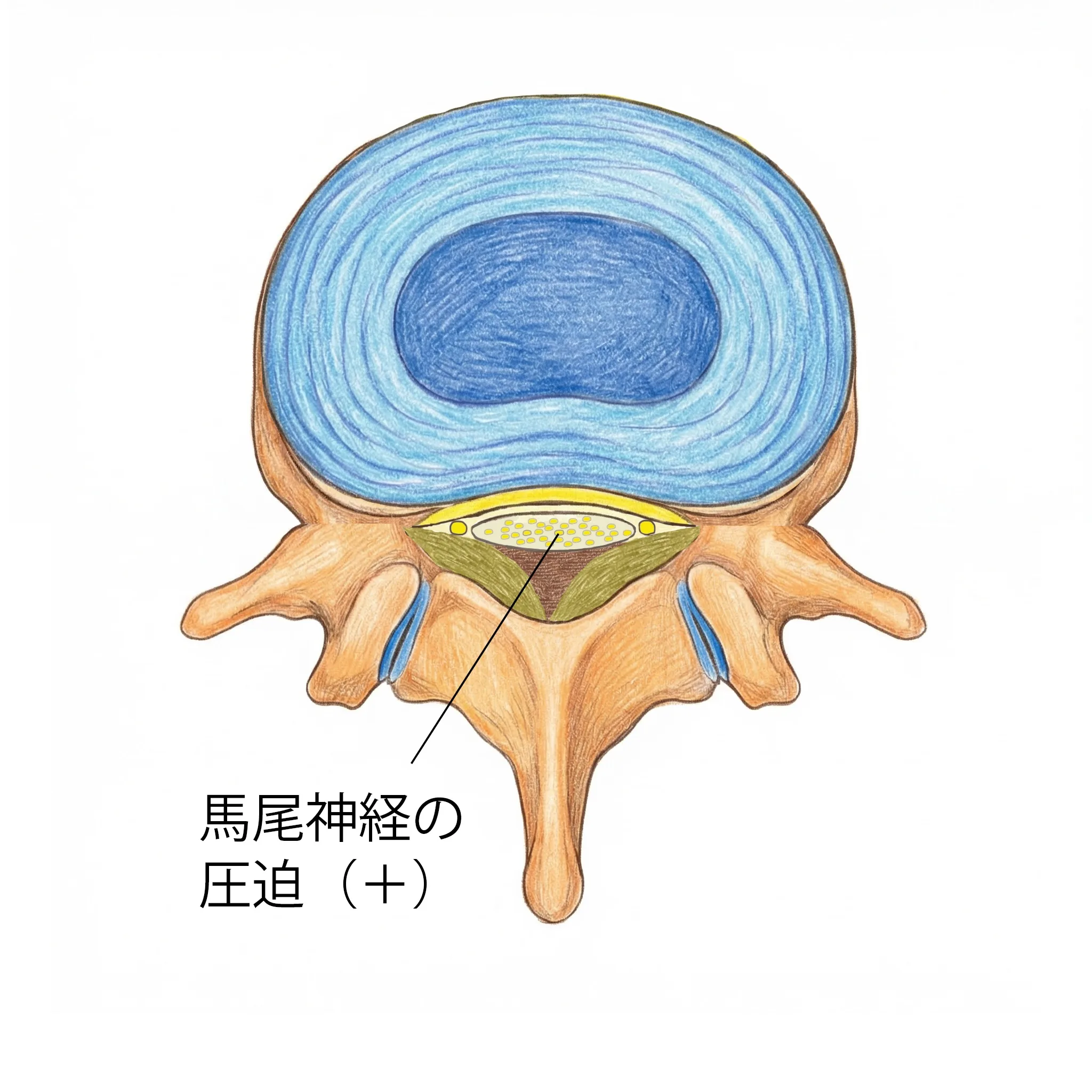 中心性狭窄:脊柱管の真ん中が狭くなり、神経が圧迫される