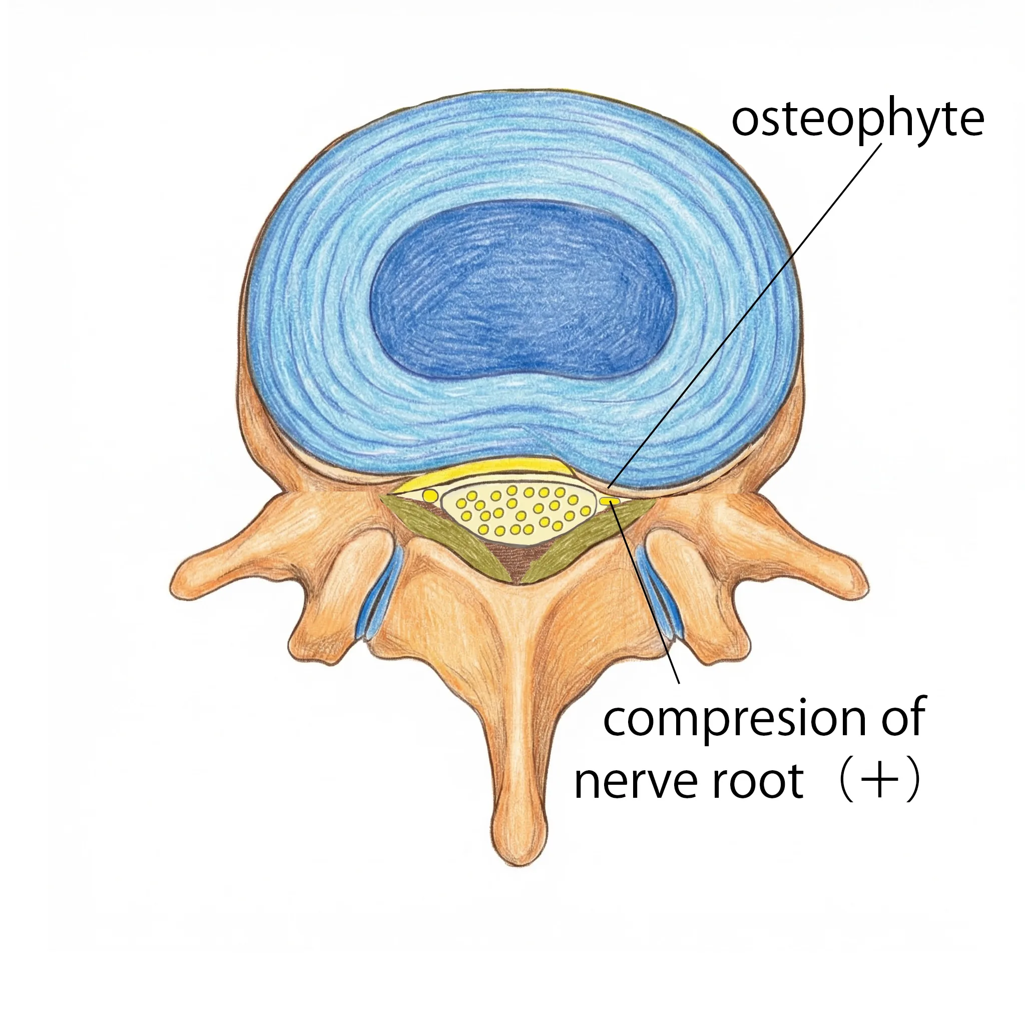 Lateral stenosis: the nerve exit (foramen) on one side is narrowed