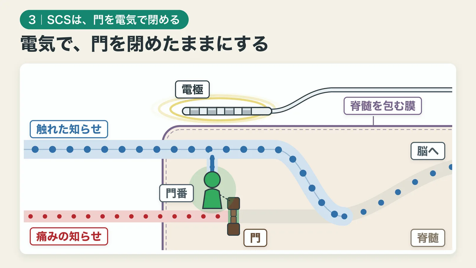 電極は脊髄を包む膜の外に置く。電気で太い道を動かし、門を閉めたままにする
