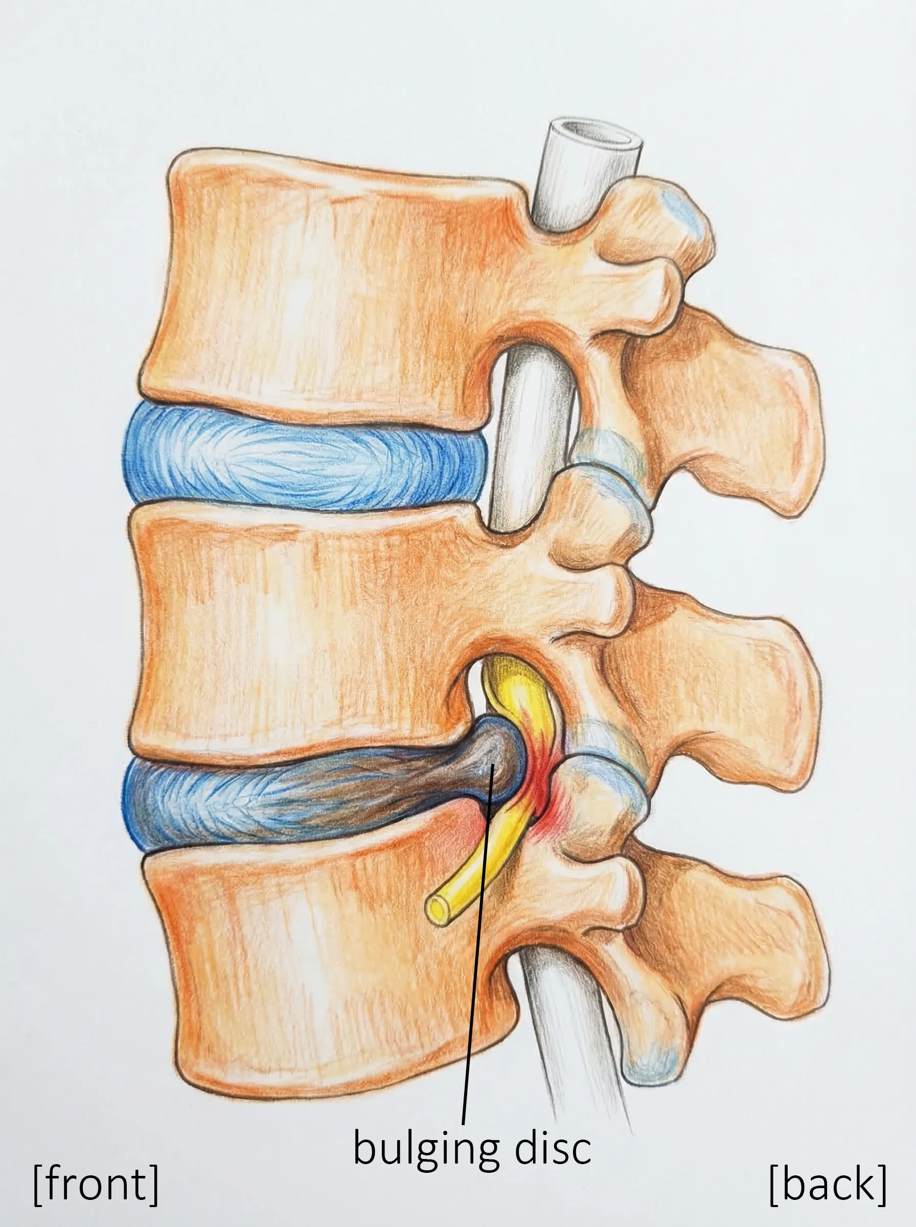 A bulging disc compressing the spinal canal