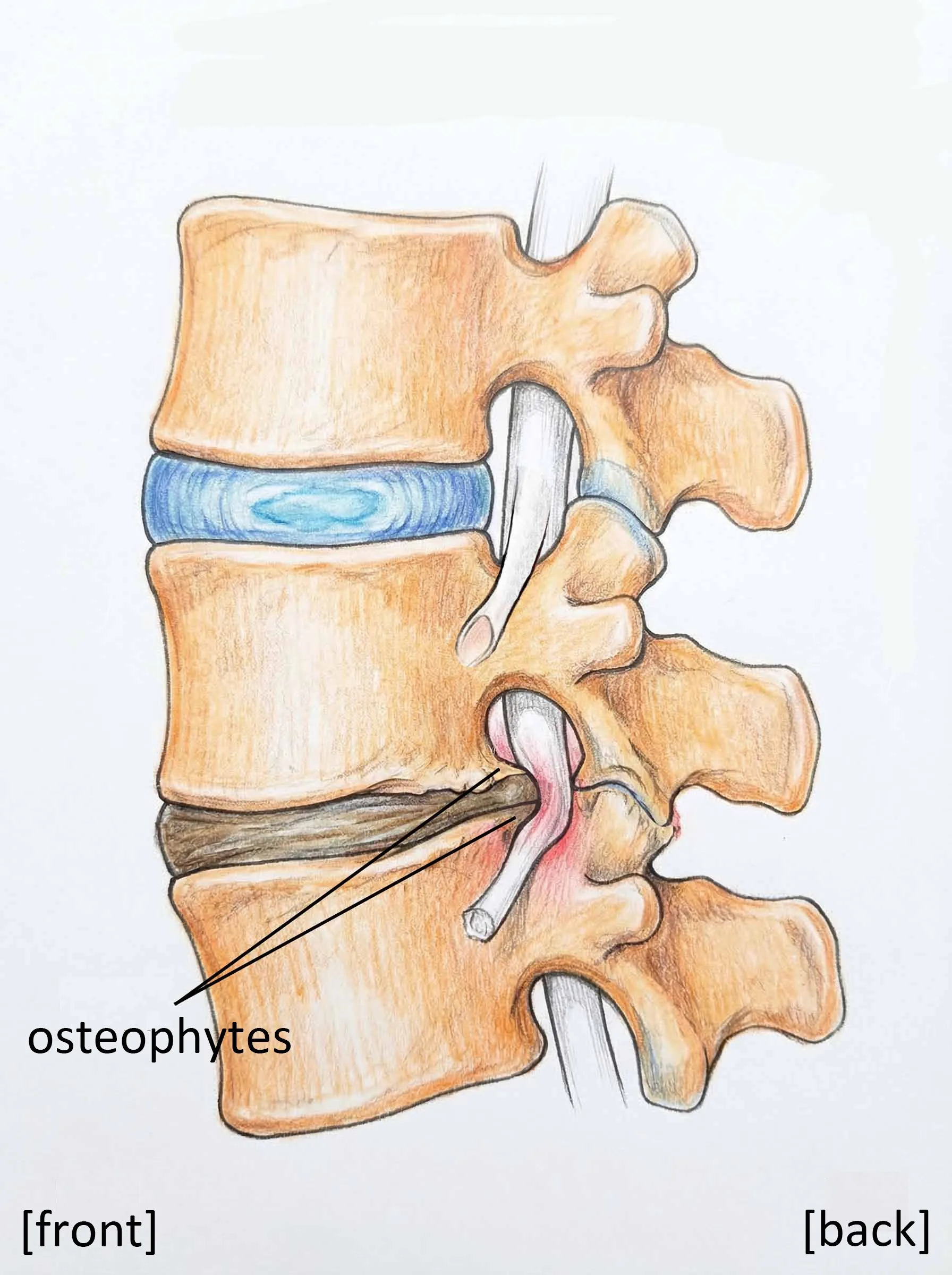 Osteophytes (bone spurs) forming along the edges of the vertebrae