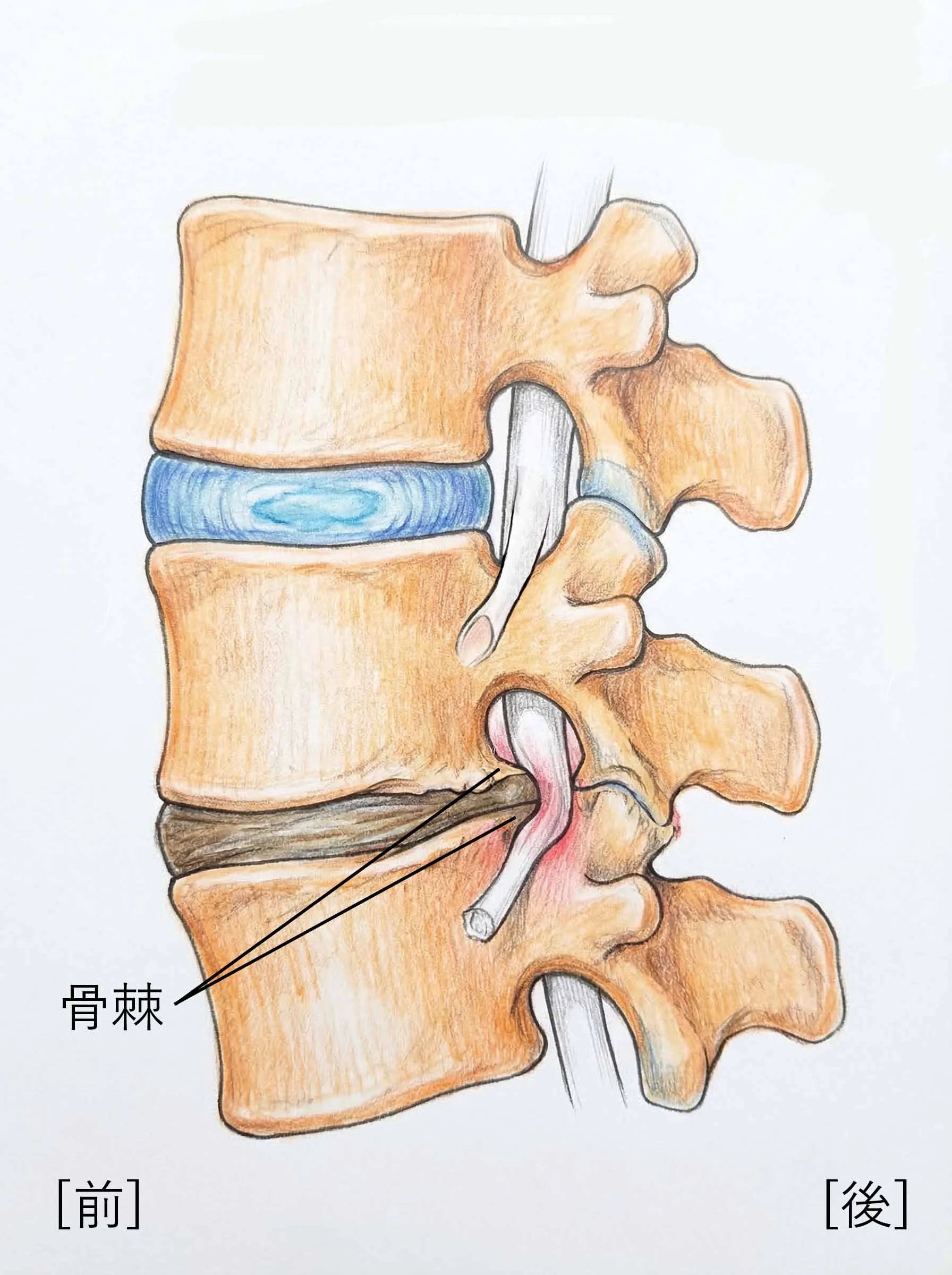 骨棘が形成された腰椎の側面図
