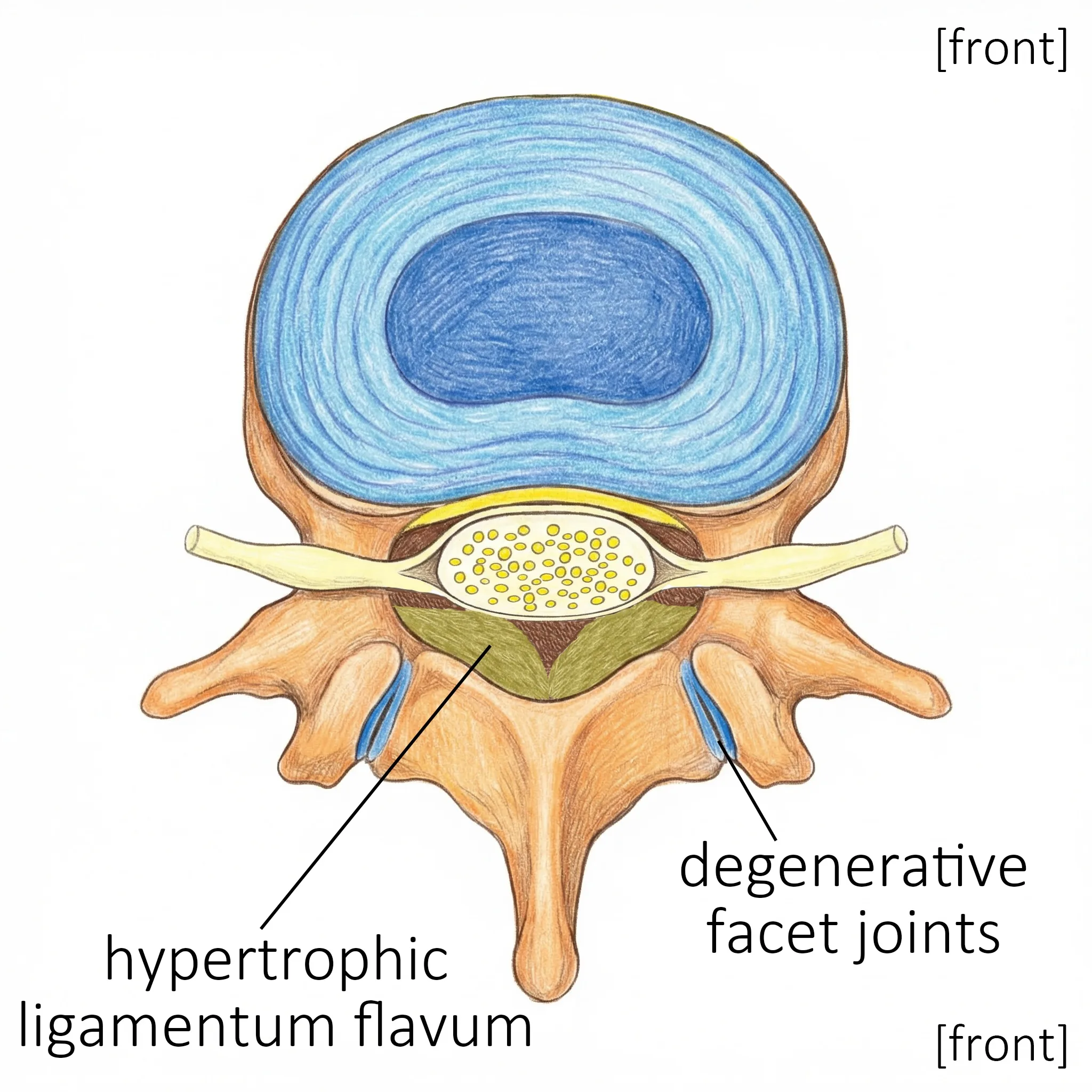 Cross-section of a stenotic spinal canal showing hypertrophic ligamentum flavum and degenerative facet joints
