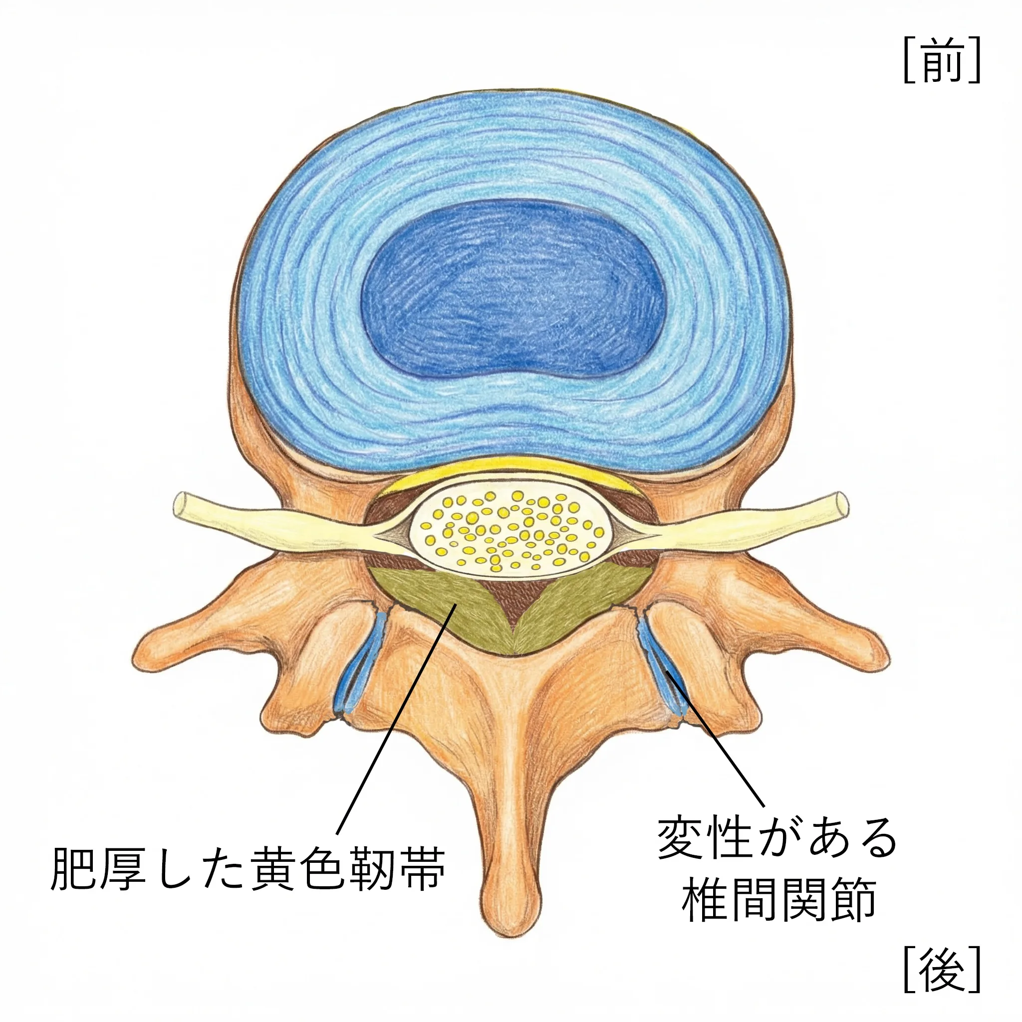 狭くなった脊柱管で神経が圧迫される様子